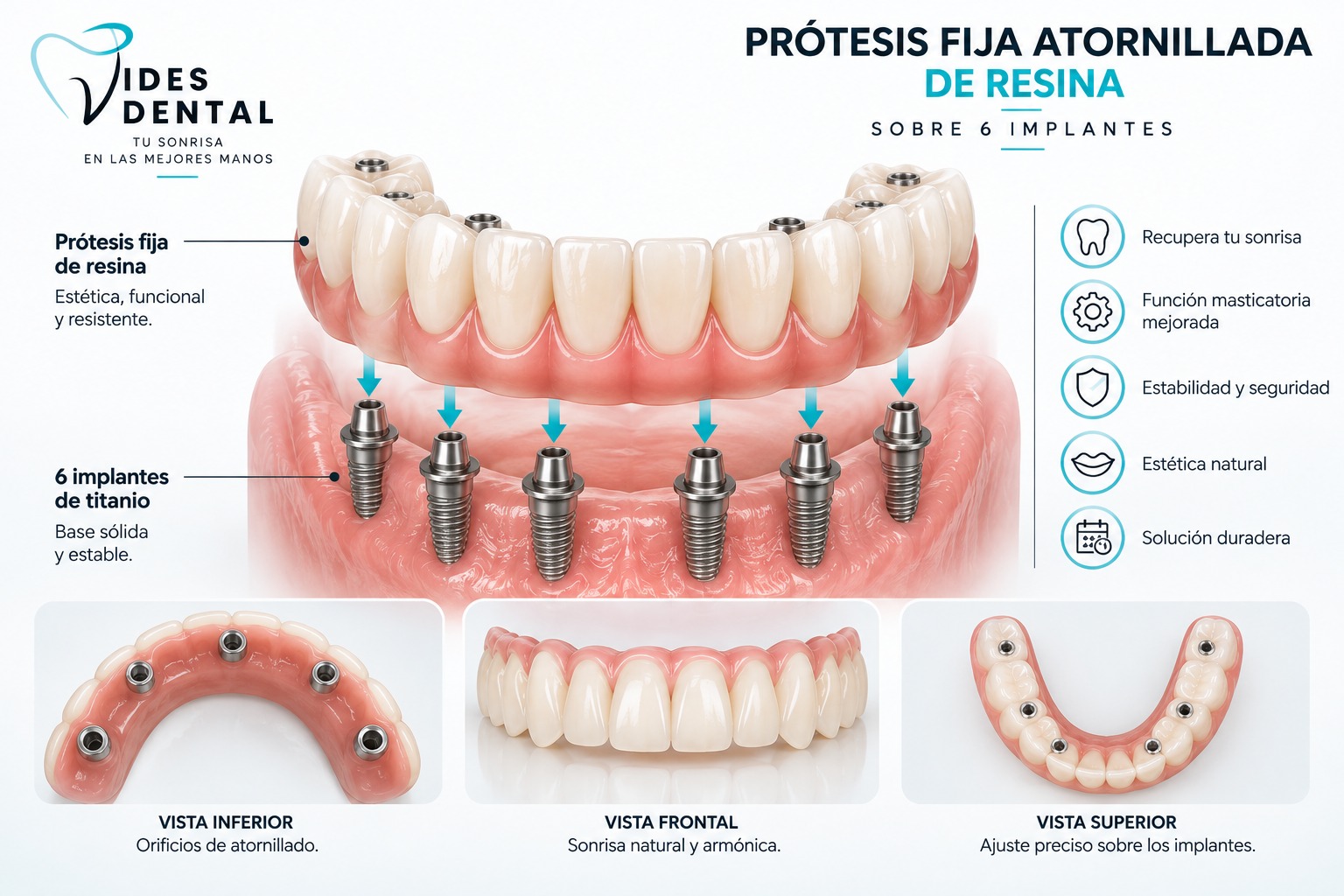 Infografía de Prótesis Fija Atornillada de Resina sobre 6 Implantes en Vides Dental