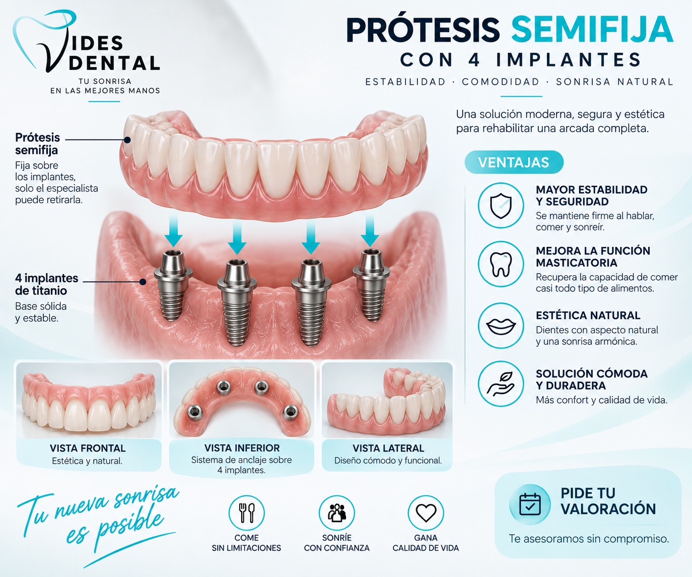 Infografía de Prótesis Semifija con 4 Implantes en Vides Dental: Estabilidad y Comodidad